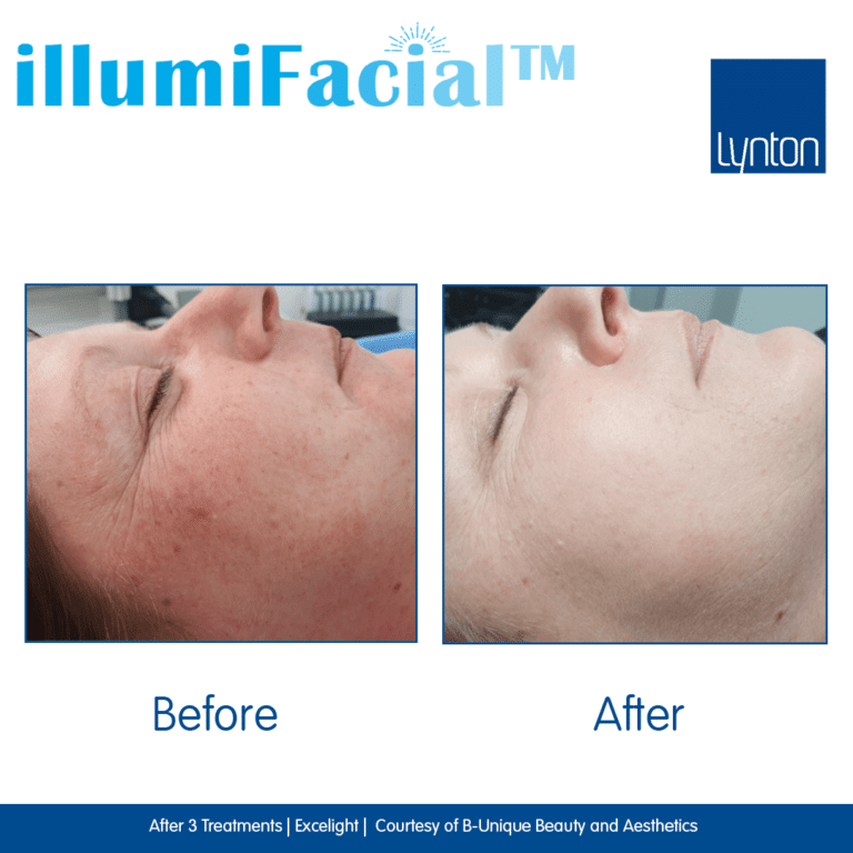 Before-and-After.-illumiFacial.-Excelight.-1.-B-Unique-Beauty-and-Aesthetics- (1)
