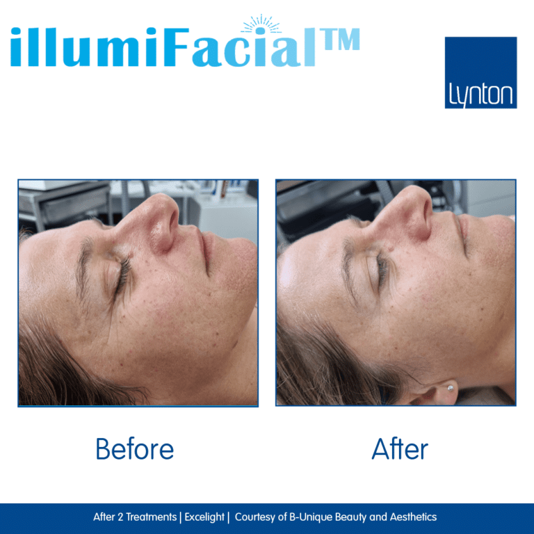 Before-and-After.-illumiFacial.-Excelight.-2.-B-Unique-Beauty-and-Aesthetics- (1)