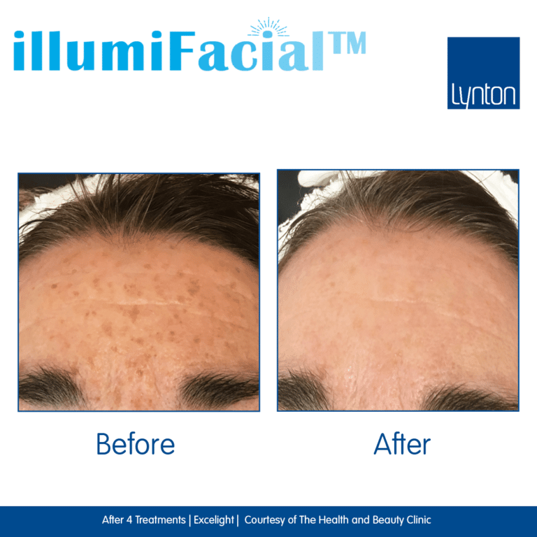 Before-and-After.-illumiFacial.-Excelight.-The-Health-and-Beauty-Clinic- (1)