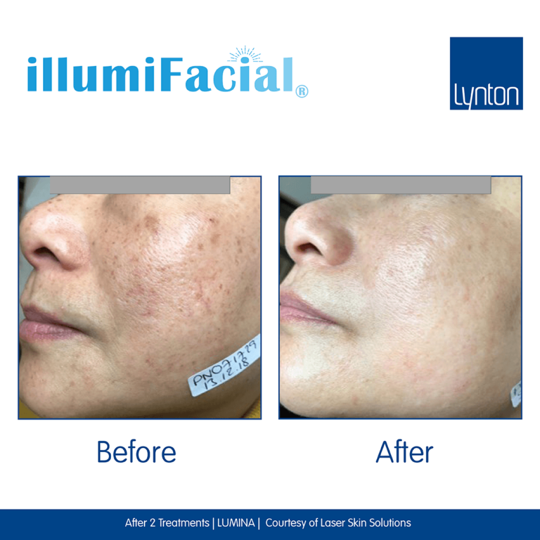 Before-and-After.-illumiFacial.-Lumina.-Laser-Skin-Solutions- (1)