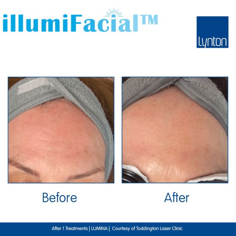 Before-and-After.-illumiFacial.-Lumina.-Toddington-Laser-Clinic- (1)