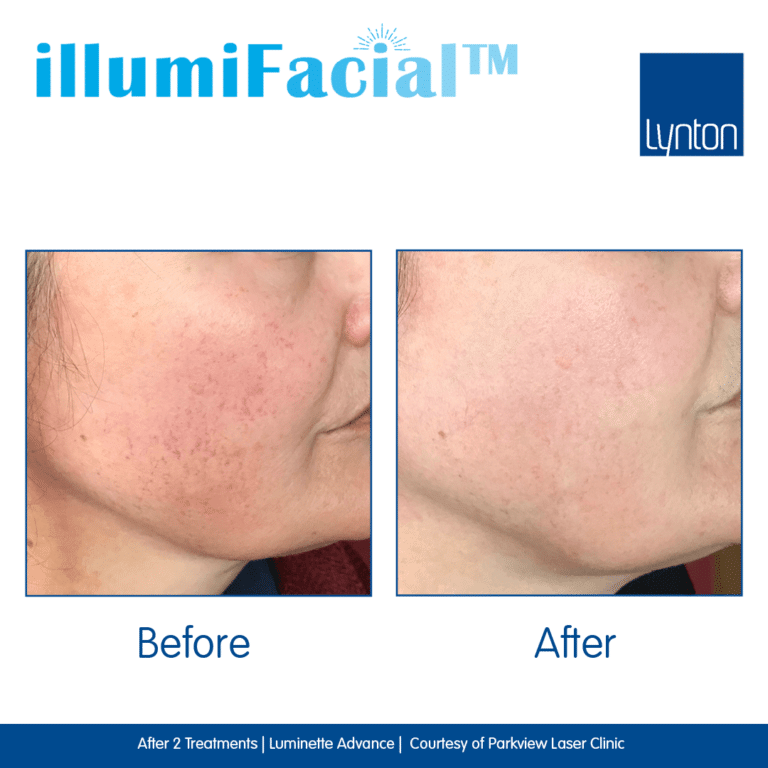 Before-and-After.-illumiFacial.-Luminette-Advance.-Parkview-Laser-Clinic (1)