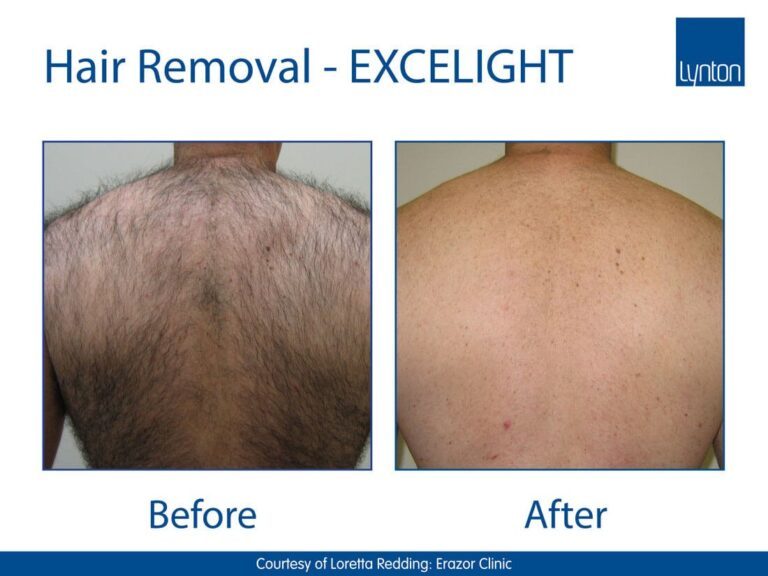 EXCELIGHT-BA-Hair-Removal-2-Back-Copy