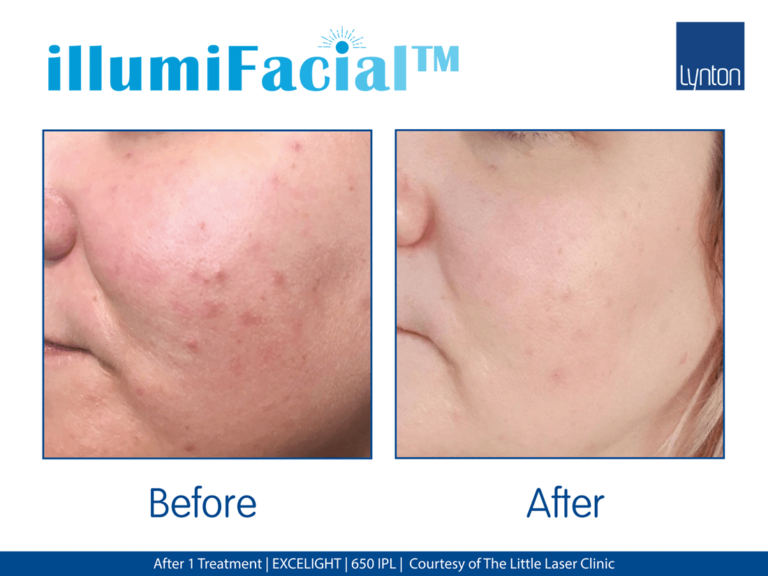 The-Little-Laser-Clinic-illumiFacial-After-1-Treatment (1)